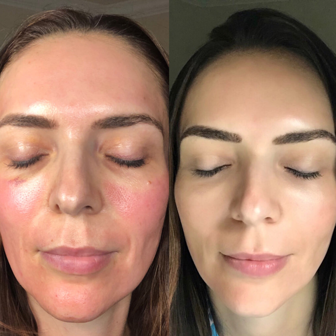 CO2 Lift Pro Carboxy Gel Treatment
