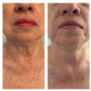 CO2 Lift Pro Carboxy Gel Treatment