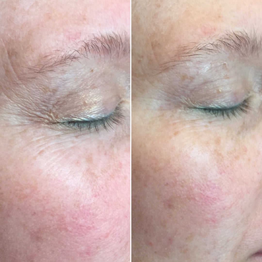 CO2 Lift Pro Carboxy Gel Treatment