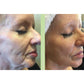 CO2 Lift Pro Carboxy Gel Treatment