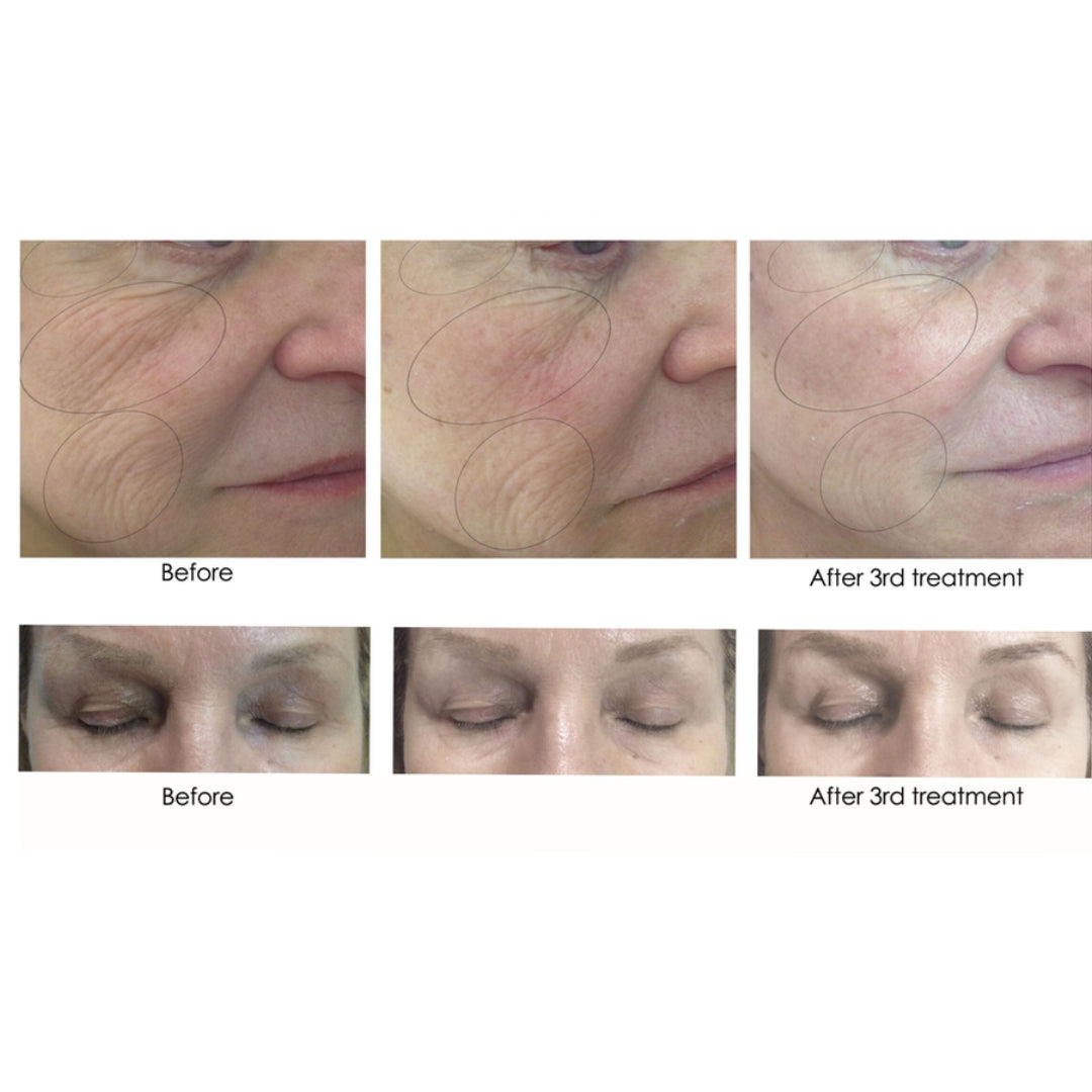 CO2 Lift Pro Carboxy Gel Treatment