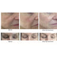 CO2 Lift Pro Carboxy Gel Treatment