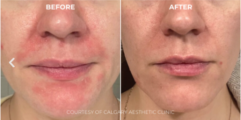 Hale Derma Spray