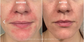 Hale Derma Spray